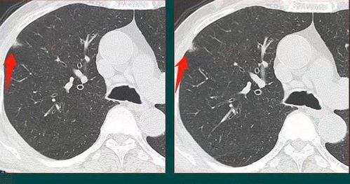 查出肺结节,有些是癌细胞入侵,医生教你用CT片找出恶性肺结节