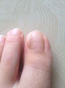 刚做完甲沟炎手术 请问我这个伴有灰指甲吗 左脚大拇指边上发黑是淤血还是灰指甲 右脚边上是像起泡一样 