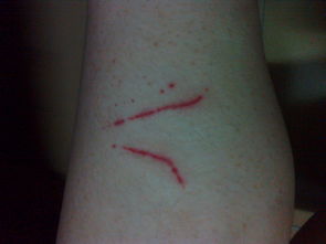 被猫抓伤后伤口周边发红,求专业回答 