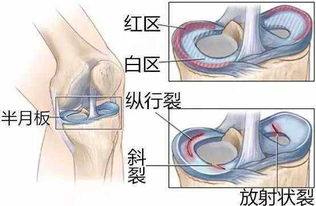 NBA球员膝盖摘除半月板后对生活造成哪些影响 