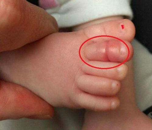 1岁宝宝脚趾有 虫子 ,宝妈带去医院检查,医生 怎么当妈的