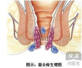 痔疮手术要几天恢复正常