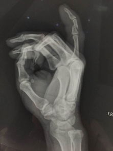右手小手指骨折,做手术大约费用多少 