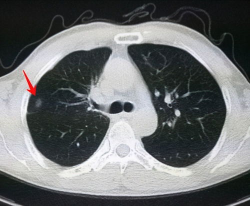 呼吸科医生 一旦查出肺结节,5个习惯尽早改,避免肺结节长大