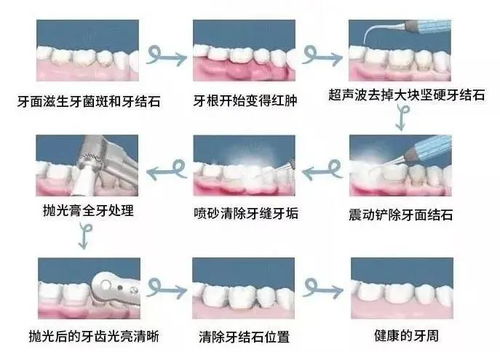 如何判断自己要不要洗牙 每个人都需要洗牙吗 看这里就知道啦