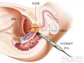 前列腺癌怎么查