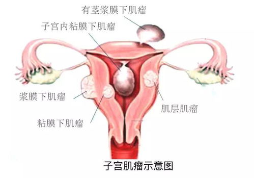 子宫肌瘤的病因，子宫肌瘤是什么原因引起的