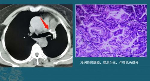 肺癌手术后1.5年复发扩散,医生说她1年前不该转让体检名额