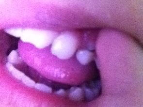 为什么牙齿上面还长了一颗牙齿 严重吗 