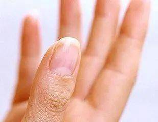指甲半月痕，指甲上的半月痕是怎么回事