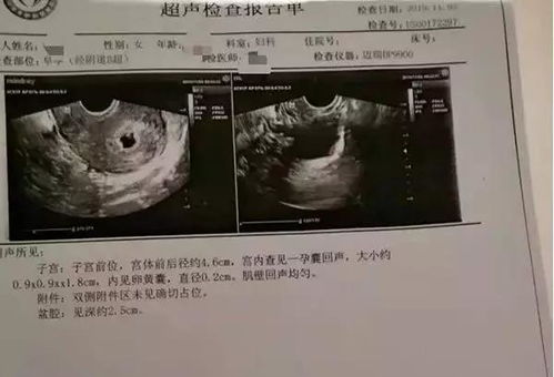 男子结扎4个月,妻子查出怀孕 结扎前,要先弄清这4个问题