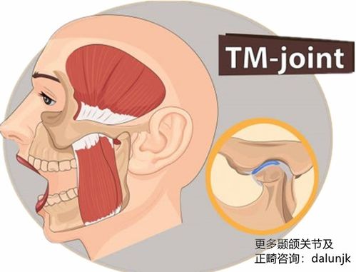 牙科专家解读 杭州颞颌关节紊乱患者还能矫正牙齿吗