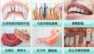 种植牙和镶牙到底谁好 比下就知道了 