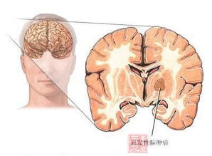 深圳一少年昏迷七天未苏醒 检查竟患脑肿瘤 