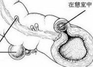 膀胱憩室并发症膀胱憩室会引发什么疾病