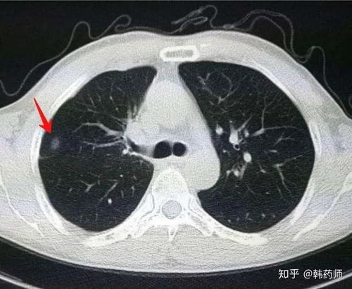 得了肺结节,该怎么办 平常需要注意什么 