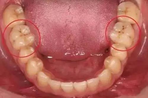 牙齿变黑了 形成的原因有三个 