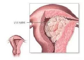 宫腔灌注是怎么操作的,宫腔灌注：女性健