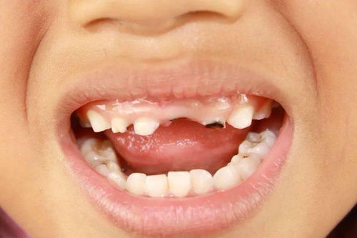 4岁男孩牙齿几乎全黑 6岁前,千万别让孩子自己刷牙