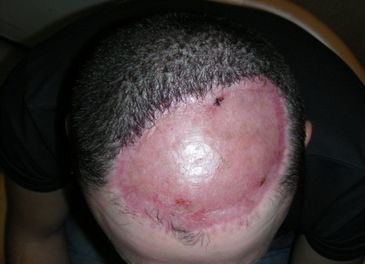 男子头皮植入气球帮助头皮复原 需6个月康复期 