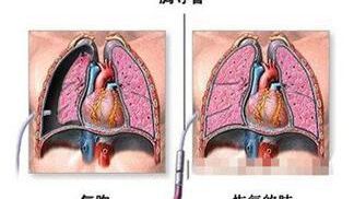 慢阻肺患者发生气胸能完全治愈吗