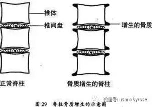 骨质增生到底能不能补钙 