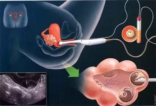 卵巢功能衰退女性不孕试管婴儿超声检查能看什么？