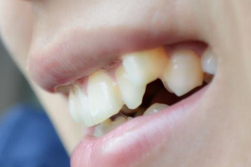 为什么有些人的牙缝很大 哪些原因导致的 希望你早点了解