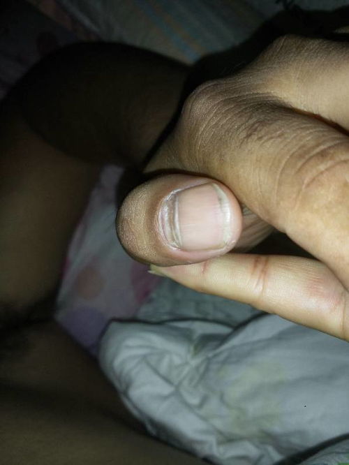 左手大拇指月牙处的指甲烂了,是什么原因 