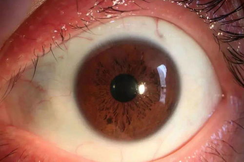 可怕 睫毛上查出18只螨虫 眼红眼痒可能不是揉眼睛这么简单
