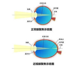 别把散光当近视,不是一回事 孩子散光影响尤其大 