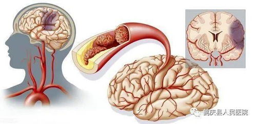 腔隙性脑梗死需要治疗吗