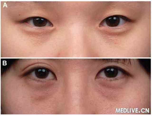眼睑汗管瘤与皮脂腺增大鉴别治疗2例 