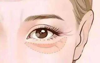 如何去眼部皱纹，怎样去除眼部皱纹最有效 三个妙招轻松去眼纹