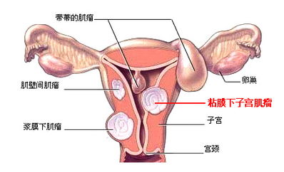 多发性子宫肌瘤的治疗方法