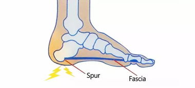 足跟痛怎么办 是什么原因