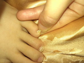 女生左脚小脚趾有痣代表什么
