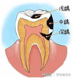 孩子明明不爱吃糖,为什么还长蛀牙