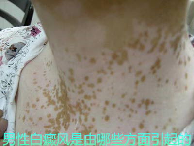 北京治疗白癜风的医院：白癜风是一种常见的皮肤病，其特点是皮肤上出现白斑，影响患者的
