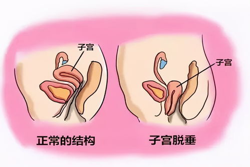 产妇顺产半个月后,身体排出 一块肉 ,检查结果显示要切除子宫