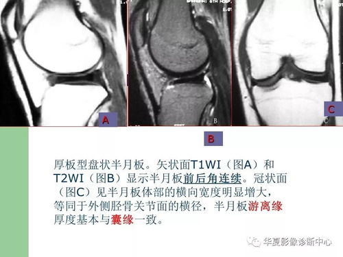 关节软骨损伤mri图片 搜狗图片搜索