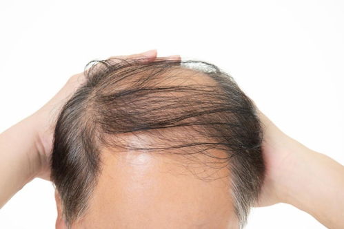 你脱发的真正原因,被找到了 如何拯救发量 医学指南给你支招