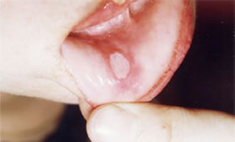 口腔溃疡喷雾喷完后舌头麻,口腔溃疡舌头麻吃什么药?