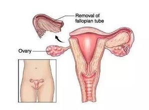 宫外孕 中的奇葩 双侧输卵管妊娠 