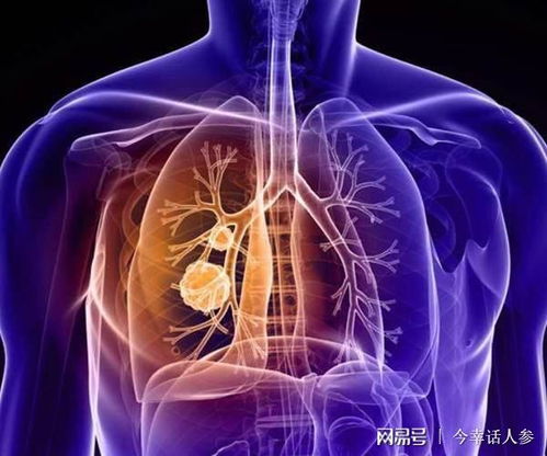 肺部小结节会不会癌变 医生 综合3个特点就能判断良恶性