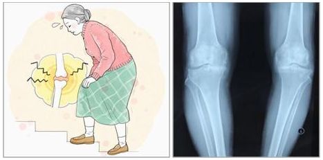 精准微创截骨保膝也许是治疗中重度膝骨关节炎最佳的治疗方式