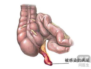 得了阑尾炎，一定要切除吗