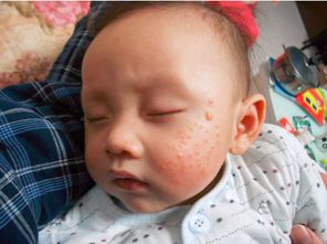婴儿湿疹有什么办法根治