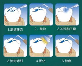 儿童窝沟封闭一颗牙多少钱,儿童窝沟封闭