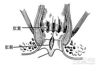 治肛裂最有效的药